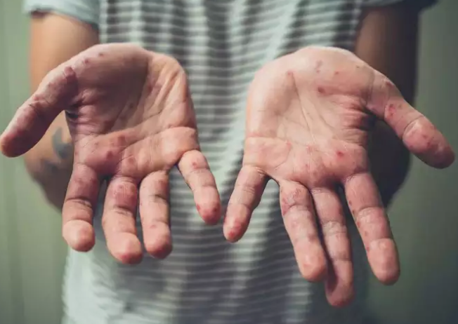 Monkeypox Symptoms in Kids