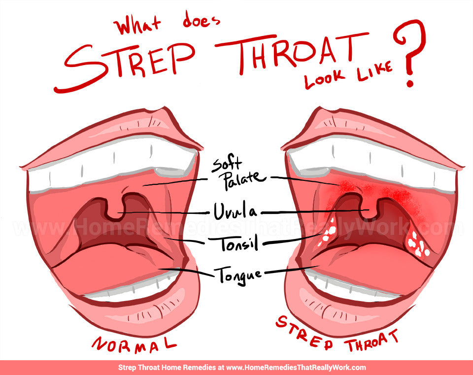 Strep Throat